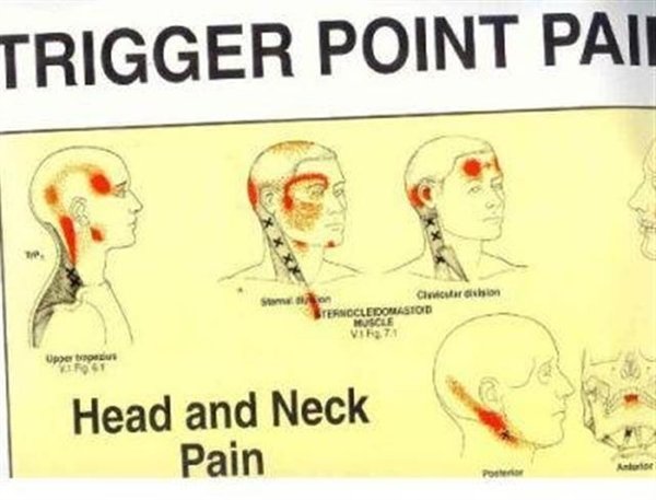 Cover Art for 9780683083682, Trigger Point Pain Patterns Wall Charts by Travell Simons